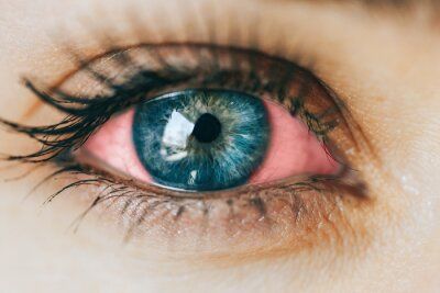 choroby oczu a zagrożenie fotobiologiczne